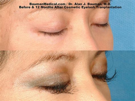 Eyelash Transplant Patient Results · Bauman Medical