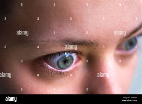 Macro Closeup Profile Portrait Of Young Woman Face With Graves Disease