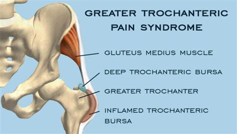Greater Trochanteric Pain Syndrome Treatment