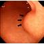 The Initial Gastroscopy Showed A 25×25 Cm Submucosal Tumor Covered 
