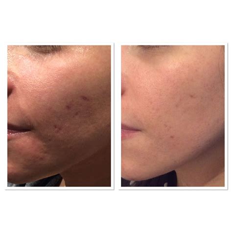 Acne Scar Before And After Treatment Parfaire Medical Aesthetics Pasadena