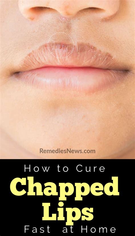 7 Natural Remedies To Get Rid Of Chapped Lips Fast At Home