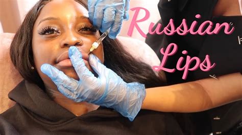 Russian Lips Technique Lip Fillers Before And After Full Procedure At