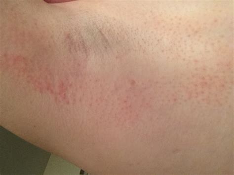 Rash Next To Armpit Why Photos Included Thread Discussing Rash Next