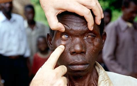 Over 1m Blind Adults Live In Nigeria — Nzelu Vanguard News