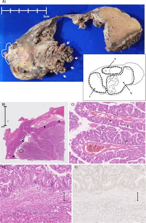 Macroscopic And Microscopic Findings Of The Resected Specimen Case