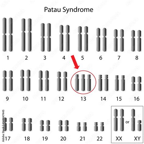 Karyotype Of Patau Syndrome Trisomy 13 Stock Illustration Adobe Stock