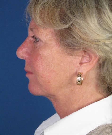 Anatomy Of Facelift Surgery Patient In San Diego Ca