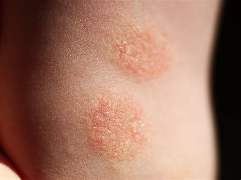 How Do You Get Rid Of Nummular Eczema Balmonds