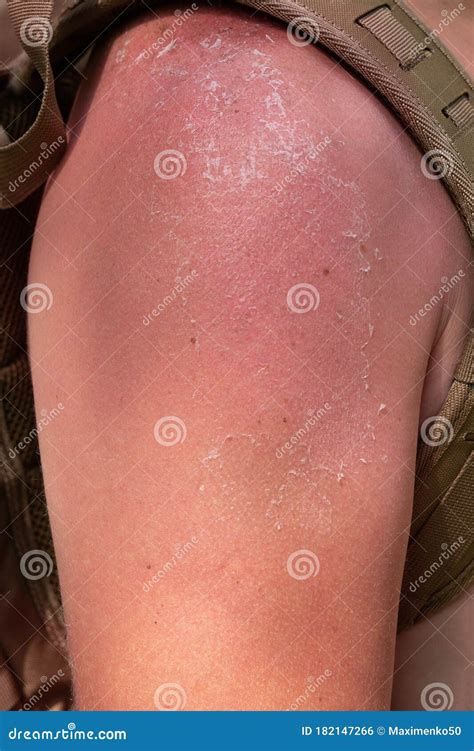 Hand In Shoulder Area Affected By Sunburn Red Inflamed Peeling Skin