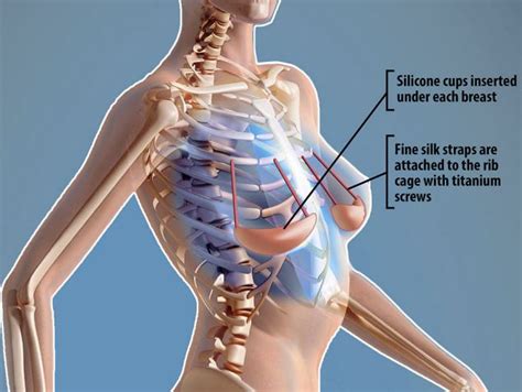 The thoracic cage (rib cage) is the osteocartilaginous structure found in the axial skeleton's thoracic region. The end of breast implants? Miracle bra UNDER the skin ...