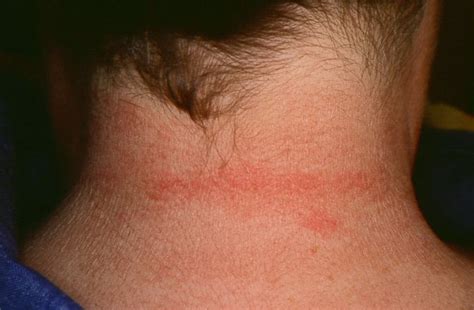 Pressure Urticaria شرى الضغط