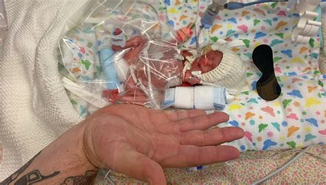 Baby Born Smaller Than Her Dads Hand And Given 10 Percent Chance Of