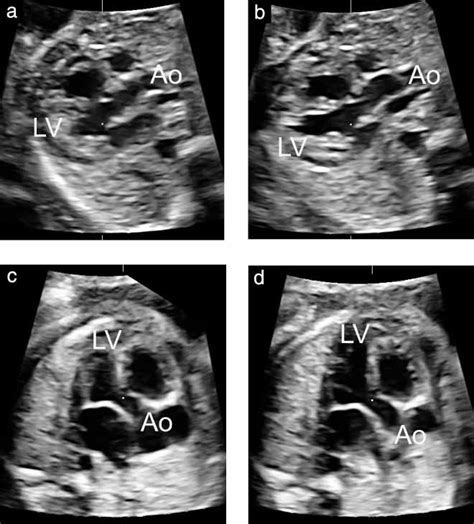 Cardiac Screening By Stic Can Sonologists Performing The 20‐week
