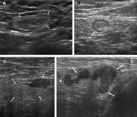 High Resolution Ultrasonographic Features Of Axillary Lymph Node