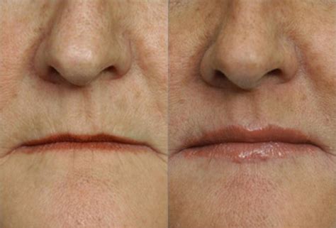 Surgical Lip Enhancement Before And After Pictures Case 118 Scottsdale Az Hobgood Facial
