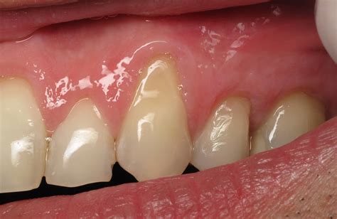 Receding Gums Symptoms Causes Complications And Risk Factors