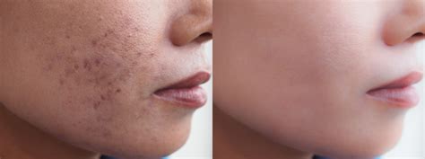 Subcision Treatment For Acne Scars By Haute Beauty Dr Michele Green Md