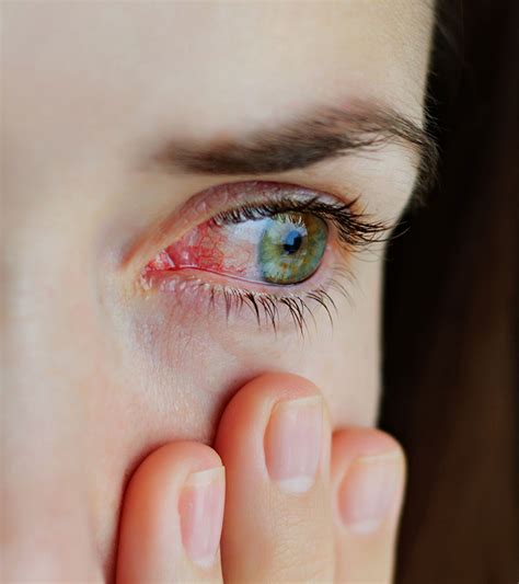 Conjunctivitis A K A Pink Eyes A Beginners Guide Hot Sex Picture