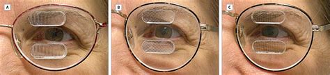 Peripheral Prism Glasses For Hemianopia Neuro Ophthalmology Jama
