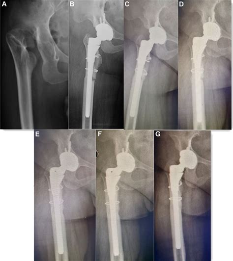 Long Term Outcomes Of Total Hip Arthroplasty With Transverse