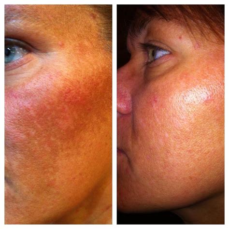 Inflamed Skin After 30 Days The Nerium Guy Flickr