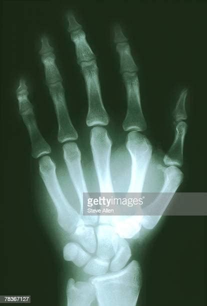 Broken Wrist X Ray Photos And Premium High Res Pictures Getty Images