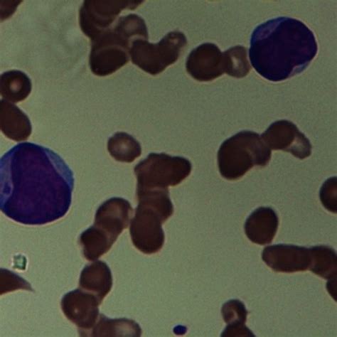 Peripheral Smear Of An Aml M2 Case Showing Blast With Auer Rods