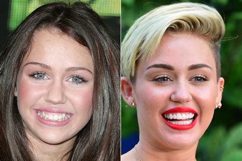 Celebrity Teeth Before And After