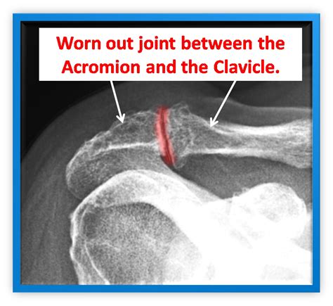 Acromio Clavicular Joint