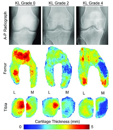 Representative A P Radiographs Of Subjects With Kellgren Lawrence KL