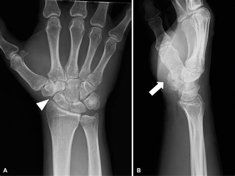 Cureus Arthroscopic Reduction And Internal Fixation For Peritrapezium