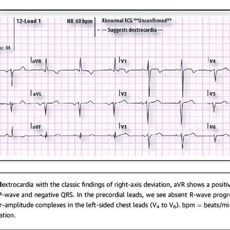 Left Sided Ecg Of A 50 Year Old Man With Dextrocardia Situs Inversus