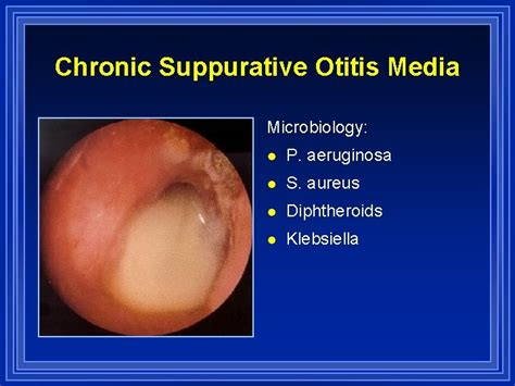 Otitis Media And Eustachian Tube Dysfunction R Kent