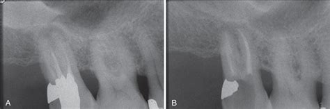 A Second Upper Molar X Ray Showed A Chronic Apical Periodontitis On