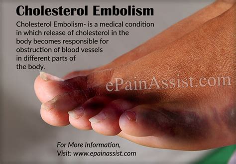 Cholesterol Embolism Or Purple Toe Syndromecausessymptomsdiagnosis