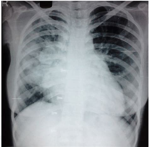 Chest X Ray Showing Multi Lobulated Opacity In Right Mid And Lower