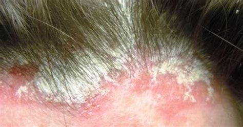 Saç Derisi Egzaması İçin Hangi Sabun İyi Gelir? | Kashni Store Türkiye