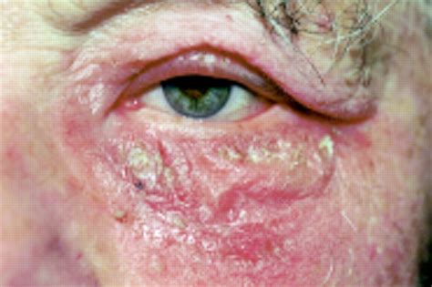 Periorbital Dermatitis As A Side Effect Of Topical Dorzolamide