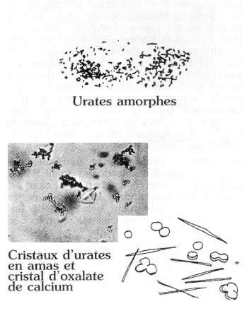 Les Cristaux Urinaires Devsante Org