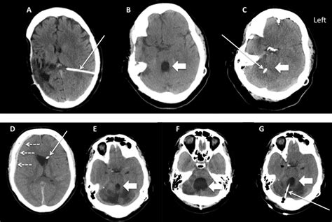 The Isolated Fourth Ventricle Bmj Case Reports