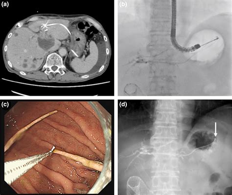 Internal Drainage By Cutting The Nasobiliary Tube After Endoscopic