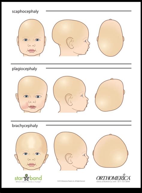 Cranial Helmet Therapy For Babies Can It Really Fix A Flat Head