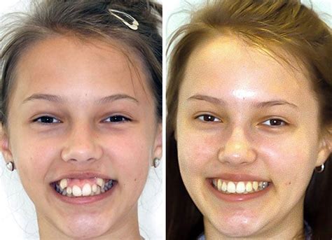 114 Incredible Before And After Transformations Of People Who Wore Braces