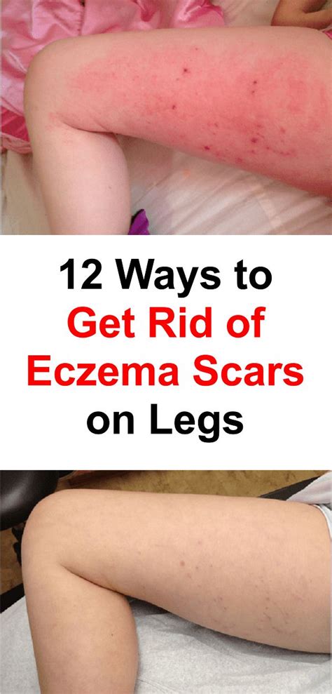 12 Ways To Get Rid Of Eczema Scars On Legs And Body