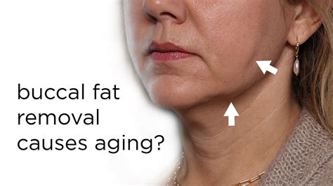 Does Facial Slimming Buccal Fat Pad Removal Bichectomy Make You Age