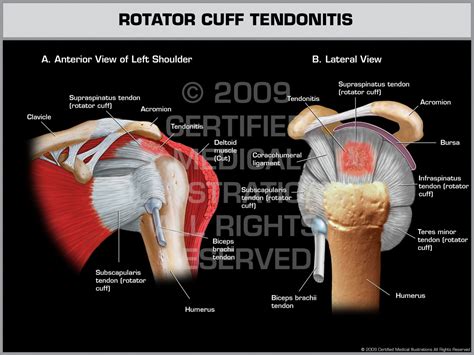 Rotator Cuff Tendonitis Left