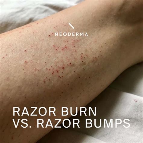 Razor Burn Vs Razor Bumps Neoderma
