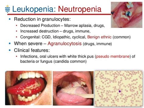 Haematology For Dental Students Wbc Disorders