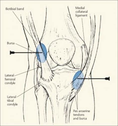 Pes Anserine Bursitis The Pain Source Makes Learning About Pain Painless